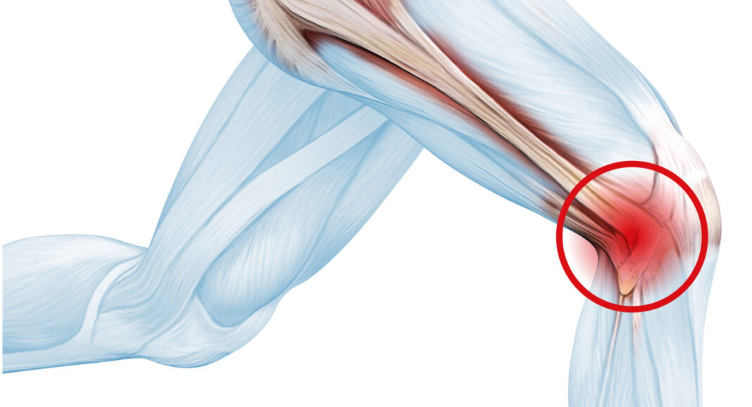 Running and IT Band Pain